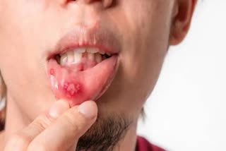 Mouth ulcer home remedy News