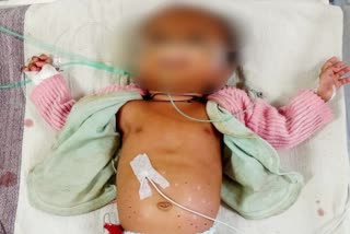 shahdol baby burnt with hot rods