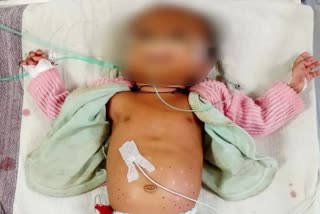 mp-shahdol-name-of-treatment-3-month-old-innocent-burnt-with-hot-rods