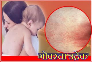 Measles vaccination in Mumbai
