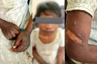 Minor girl tortured by Gurugram couple