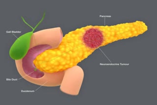 pancrease