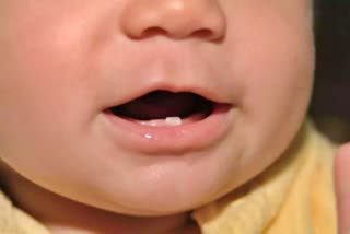 Dental Problems In Children . Tooth agenesis in children . children missing teeth