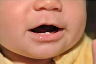 Dental Problems In Children