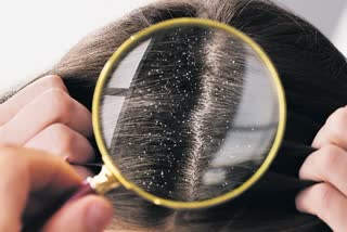 dandruff removal tips