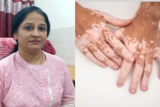 Health Tips For Vitiligo