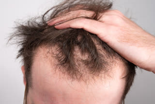 Causes of hair loss and treatment