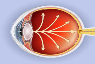 eye disease