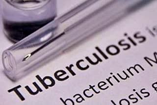 TB tuberculosis