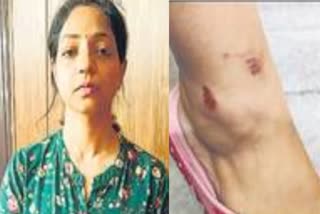 dog bitten the neighbor woman in apartment in agra case registered against owner