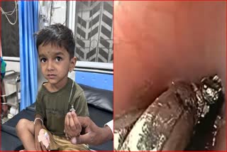 Statue Stuck in Child's Oesophagus