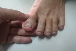 Leg Finger Pain News
