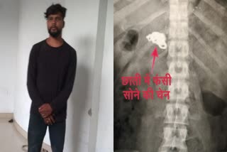 thief-swallowed-gold-chain-in-ranchi-is-in-trouble