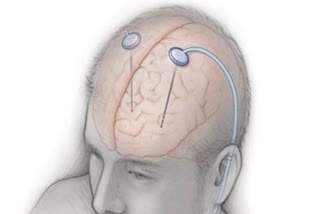 Parkinsons Disease  pacemaker  brain pacemaker  brain  Deep Brain Stimulation  DBS  depression  OCD  epilepsy  പാര്‍ക്കിന്‍സണ്‍സ് സാവിത്രി  പാർക്കിൻസൺസ്  അപൂര്‍വ്വ ശസ്‌ത്രക്രിയ  സര്‍ ഗംഗാ റാം ആശുപത്രി  പാർക്കിൻസൺസ് രോഗി  എന്താണ് പാര്‍ക്കിന്‍സണ്‍സ്  തലച്ചോറില്‍ ഡിബിഎസ് ശസ്‌ത്രക്രിയ