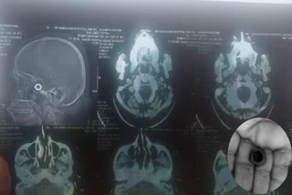 iron nut in patient's head