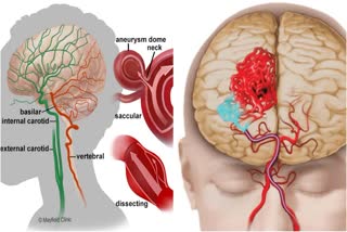 Brain aneurysm disease