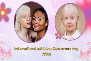 International Albinism Awareness Day 2023