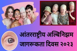 International Albinism Awareness Day 2023