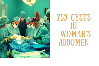 759 cysts removed from woman's abdomen in Chennai hospital