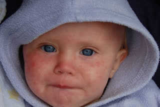 Measles killed 140,000 stagnating vaccine rates