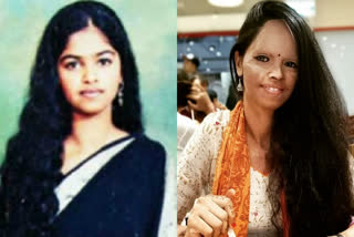 acid attack survivor Laxmi Agarwal lifestory,ಆ್ಯಸಿಡ್ ದಾಳಿ ಸಂತ್ರಸ್ತೆ ಲಕ್ಷ್ಮೀ ಅಗರ್​ವಾಲ್