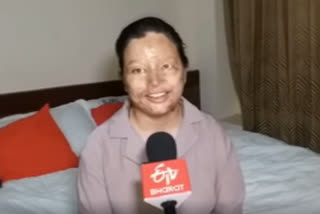 Acid Attack Survivor from Nepal