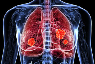 Lung Cancer