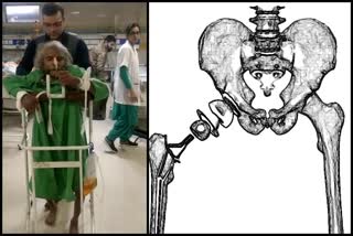 chandigarh doctors done 110 year old female hip replacement surgery