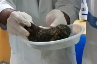 doctors removed 500 grams of hair, shampoo packets and hair from teen stomach, பெண் வயற்றில் முடி ஷாம்பு பாக்கெட்