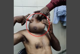 ಪುರುಷನ ಕತ್ತಿನ ಭಾಗದಲ್ಲಿ ಬೆಳೆದ ಸ್ತನ, Breast raised on the neck part of the male