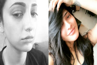 Shruti Haasan plastic surgery, ಶ್ರುತಿ ಹಾಸನ್​ ಪ್ಲಾಟ್ಟಿಕ್​ ಸರ್ಜರಿ