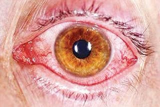 Coronavirus can linger in your eyes