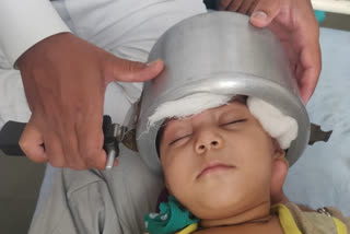 One-year-old girl's head stuck in pressure cooker