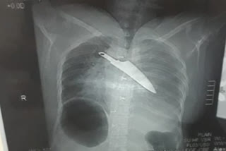 A knife recovered from womans chest after 30 hours tamilnadu