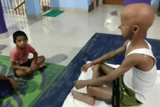 Nine-year-old Progeria patient from Thane practices yoga to maintain strong immune system