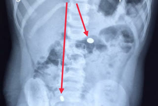 Magnets removed from Bengaluru toddler's stomach