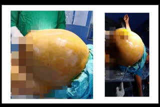 Doctors remove tumour weighing 18 kg from woman’s stomach