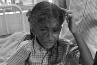 street dogs attack on seven years girl in prakasam dst