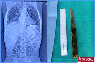 aiims doctor operate upon a patient and removed a 20 inch knife from liver