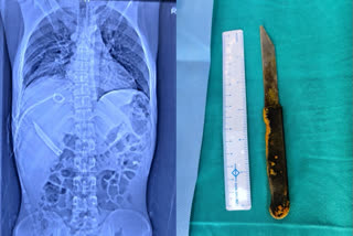 AIIMS Delhi  Knife in man's liver  Liver operation  യുവാവിന്‍റെ കരളില്‍ നിന്നും പുറത്തെടുത്തത് കത്തി  ഡല്‍ഹി എയിംസ്  ഡല്‍ഹി