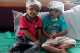 conjoint twins operation, bhubaneswar latest news, conjoint twins operation in aiims, state government writes letter to aiims director, ଯୋଡାମୁଣ୍ଡ ଅସ୍ତ୍ରୋପଚାର, ଏମ୍ସରେ ଯୋଡାମୁଣ୍ଡ ଅସ୍ତ୍ରୋପଚାର, ଏମ୍ସ ନିର୍ଦ୍ଦେଶକଙ୍କୁ ରାଜ୍ୟ ସରକାରଙ୍କ ଚିଠି, ଯୋଡାମୁଣ୍ଡ ଅସ୍ତ୍ରୋପଚାର ପାଇଁ ଡାକ୍ତରଙ୍କୁ ଧନ୍ୟବାନ, ଭୁବନେଶ୍ବର ଲାଟେଷ୍ଟ ନ୍ୟୁଜ୍‌