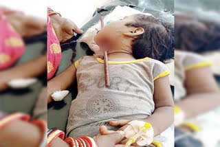 iron rod that pierced, An iron rod that pierced through girl mouth, iron rod that pierced through girl mouth in Ganjam, Ganjam girl news, Ganjam iron rod news, ಮಗುವಿನ ದವಡೆಯಿಂದ ನುಗ್ಗಿದ ಕಬ್ಬಿಣದ ರಾಡ್, ಗಂಜಾಂನಲ್ಲಿ ಮಗುವಿನ ದವಡೆಯಿಂದ ನುಗ್ಗಿದ ಕಬ್ಬಿಣದ ರಾಡ್, ಗಂಜಾಂ ಬಾಲಕಿ ಸುದ್ದಿ, ಗಂಜಾಂ ಕಬ್ಬಿಣ ರಾಡ್​ ಸುದ್ದಿ,