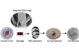 IISC Bangalore on skin cancer , skin cancer bandage