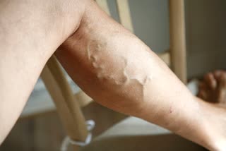 Varicose veins, a source of health problems