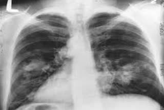 cancer screening reduces rates of lung cancer-specific death