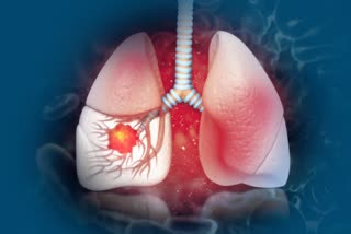 Lung cancer problem increased