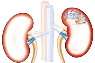 Kidney patients