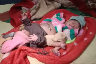 Aligarh woman births a baby with two heads, four hands