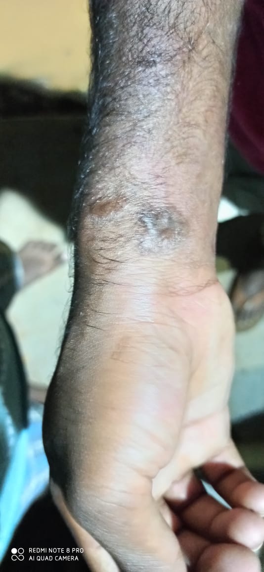 Injured hand of Varaprasad