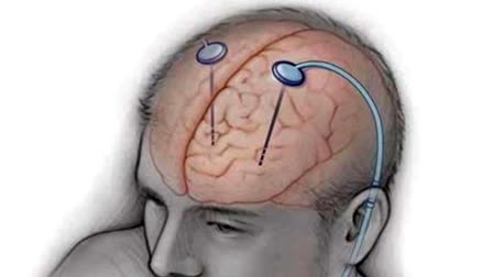 Parkinson disease